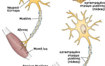 Σκλήρυνση κατά της πλάκας και έκπτωση μνήμης